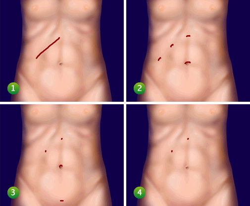 Tratamento de Pedra na Vesícula