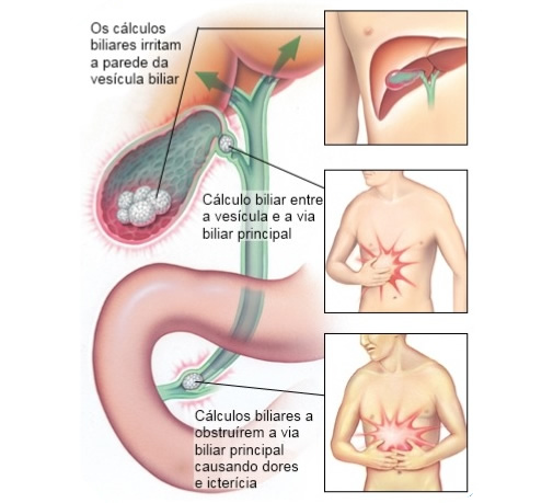 Sobre a Vesícula Biliar